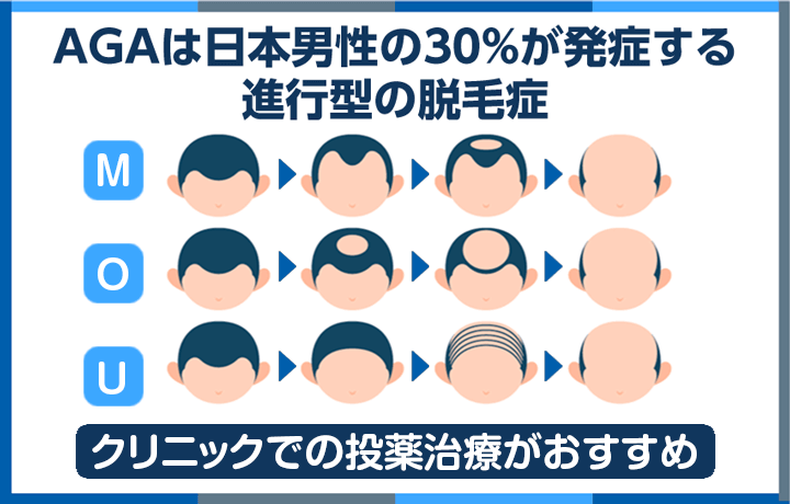 AGAは日本男性の30%が発症する進行型の脱毛症