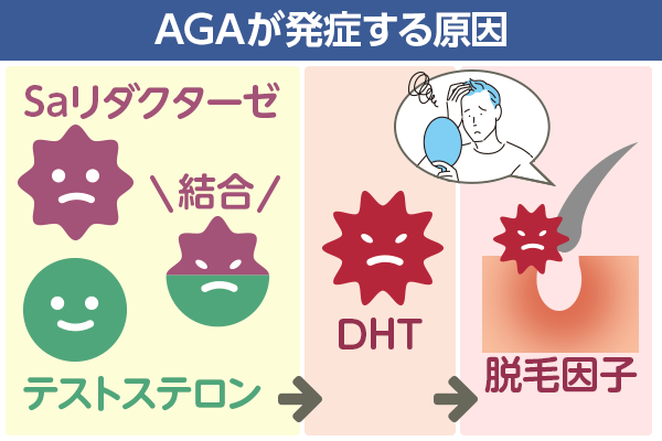 AGAが発症する原因の図解