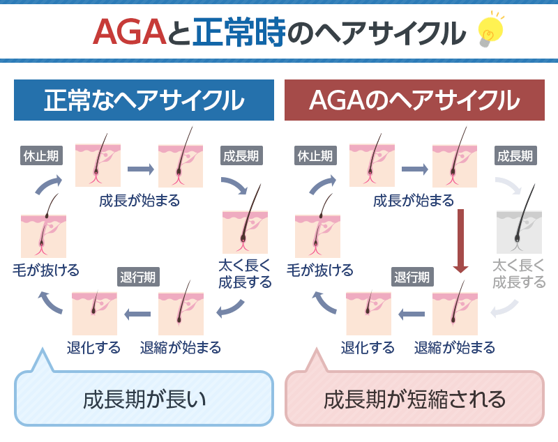 AGAと正常時のヘアサイクルの違いの図解