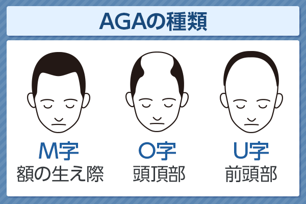 AGAの種類について解説!薄毛の進行度はハミルトン・ノーウッド分類でチェックする