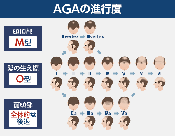 ハミルトン・ノーウッド分類でみたAGAの進行度
